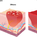 Exploring the Different Stages of Healing 2nd Degree Burns