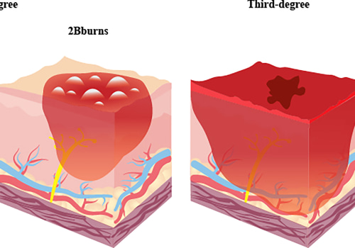 Exploring the Different Stages of Healing 2nd Degree Burns